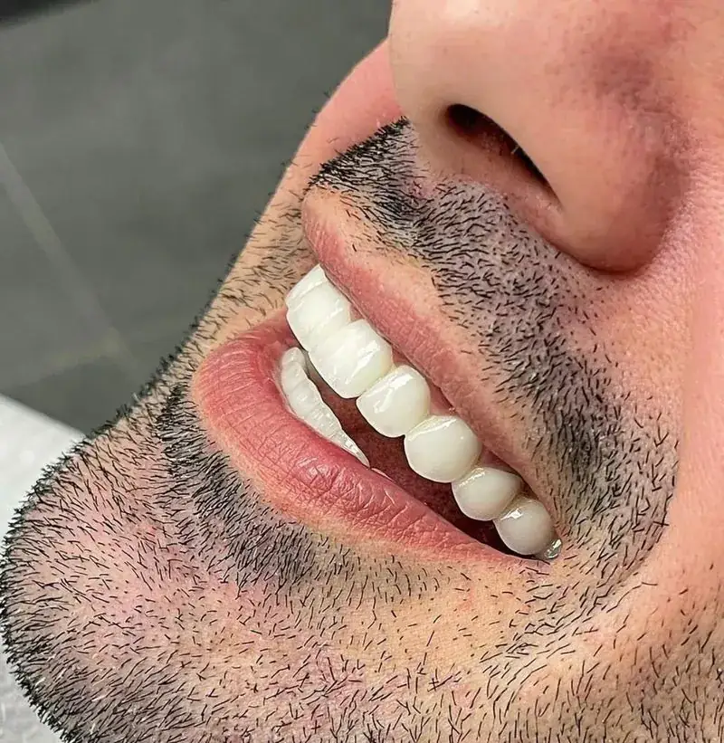 Hollywood Smile result