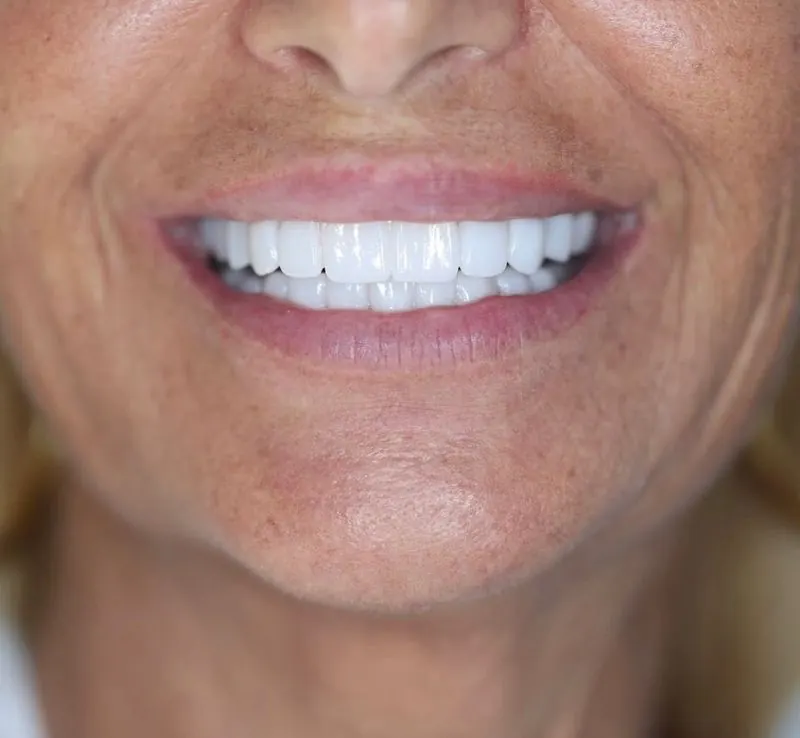 Smile restoration result