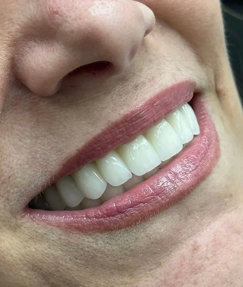 Porcelain veneers result